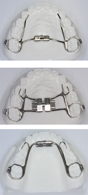 palatal expander