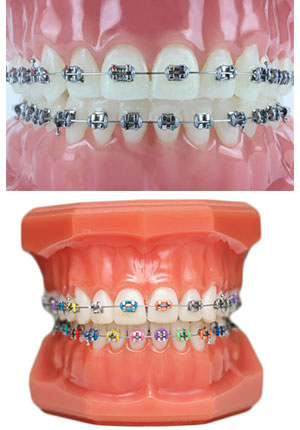 Types of Braces  Murphy & Lucas, TX - Robertson Orthodontics